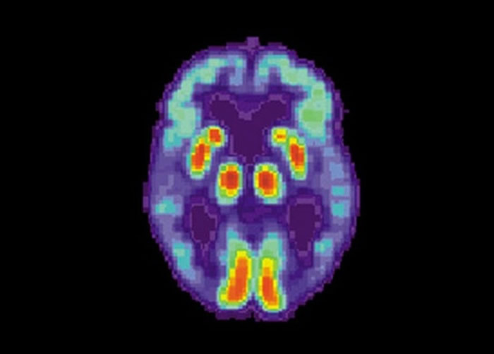 团队利用PET影像做研究。