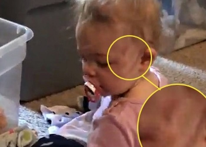 莉莉左额角出现手指状瘀痕。