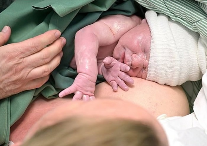 女子接受子宫移植手术后,成功诞婴。