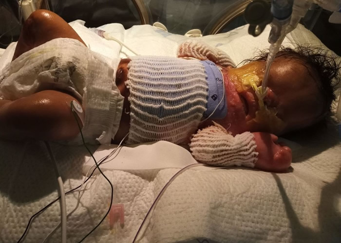 男婴颈胸黏成一块,不少地方长水疱。