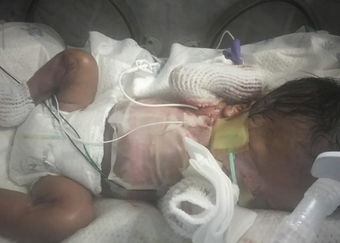 男婴无法正常呼吸。