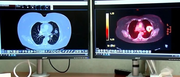 蒂彭斯在前年1月的扫描(左萤幕)和4个月后的扫描(右萤幕)有天渊之别。