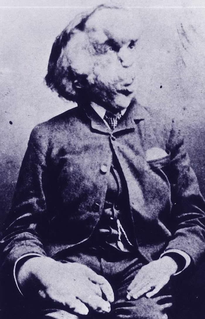 英国伦敦发现“象人”约瑟夫·梅里克Joseph Merrick墓地 病因至今没有定论