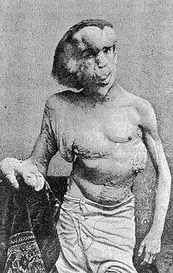 英国伦敦发现“象人”约瑟夫·梅里克Joseph Merrick墓地 病因至今没有定论