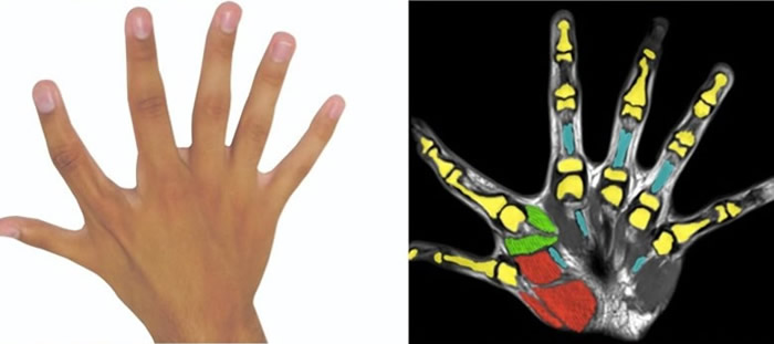 英德研究指“多指症”非缺陷 六指异士生活便利胜常人