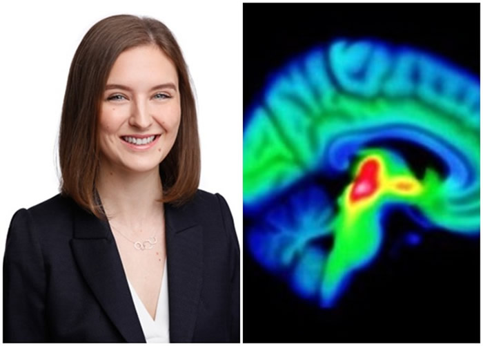 威尔逊(左图)指柏金逊症前期患者的血清素(右图红色部分)已减少。