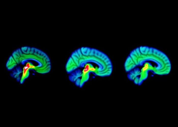 图左至右分别为健康人士、柏金逊症前期患者及已出现病征患者的脑扫描图,可见三者脑内血清素(红色)的差别。(互联网)图左至右分别为健康人士、柏金逊症前期患者及已出现
