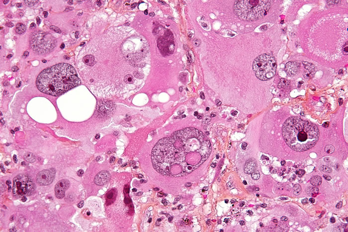 五年生存率很低 研究建议对所有胶质母细胞瘤(脑肿瘤)患者采取更积极的治疗方法