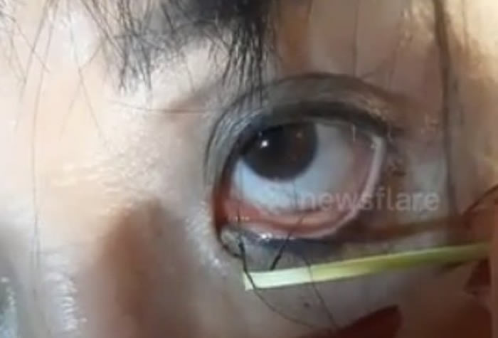 越南高平省女子习惯在溪里洗澡洗衣服 眼睛疼痛拉出数十条黑色寄生虫