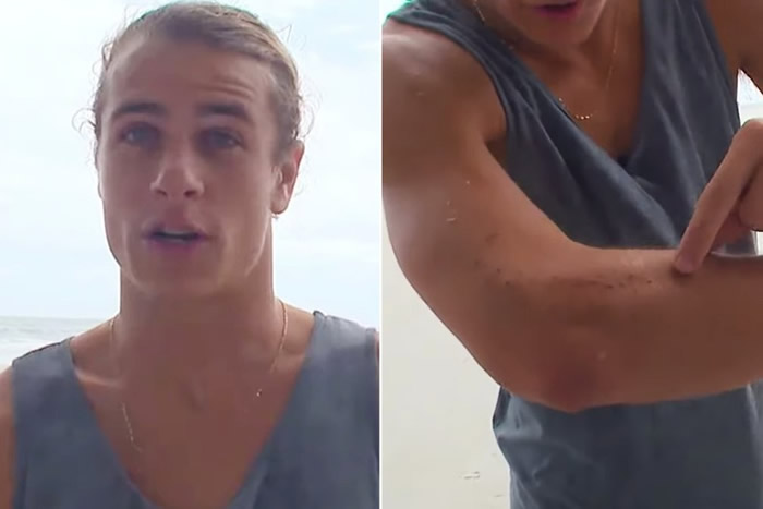 美国职业滑浪选手手肘遭鲨鱼咬 不去医院去酒吧