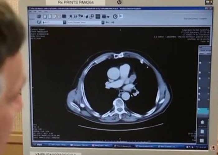 《刺针》医学期刊:癌症已超越心脏病成为富有国家最主要的死亡原因