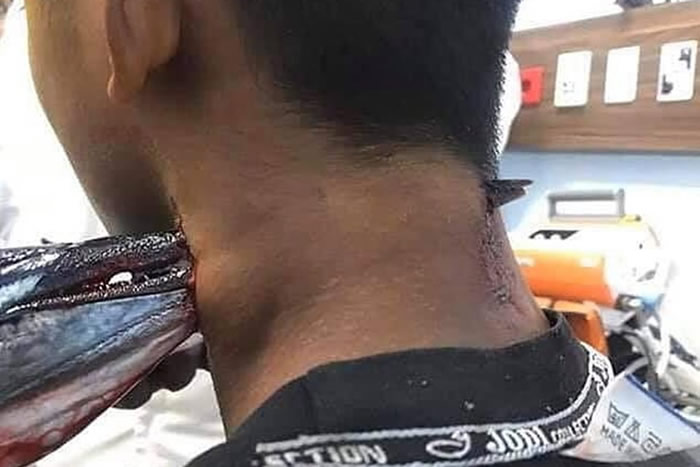 印尼16岁少年捕鱼时被跳上船的颌针鱼刺穿颈项