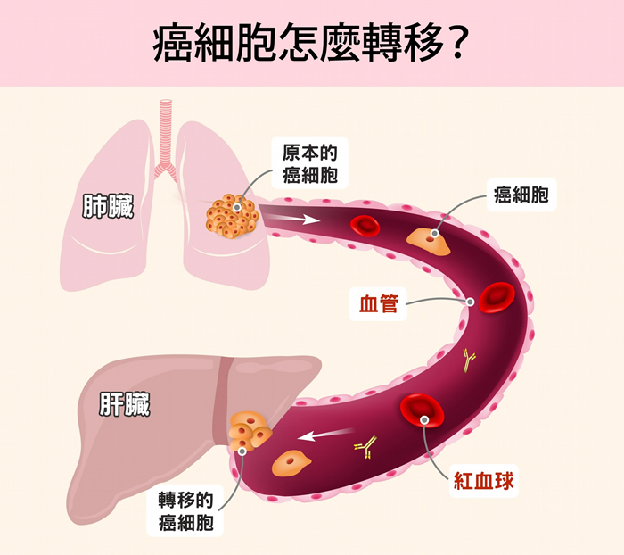 癌症(Cancer) 或称作恶性肿瘤(Malignant tumor),源自身体某个部位有细胞不正常的增生。 肿瘤形成之后,可能从原本部位向周围组织扩张,藉由淋