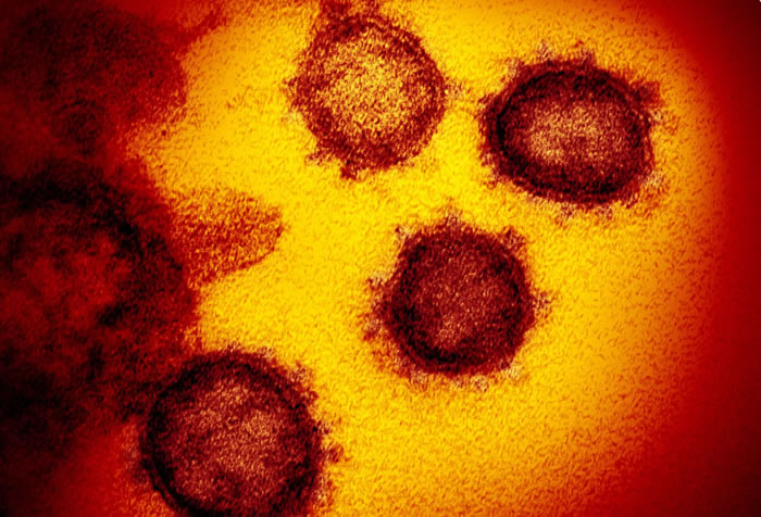 美国国家过敏和传染病研究所(NIAID)发布新型冠状病毒COVID-19最新彩色显微镜图像