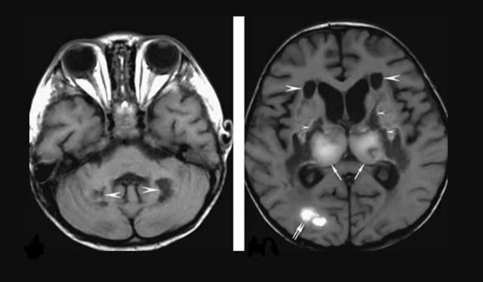 新冠肺炎患者现罕见并发症“急性坏死性脑病变” 精神错乱中风