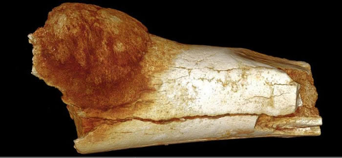 长骨肉瘤的跖骨(引自Odes et al.,2018)