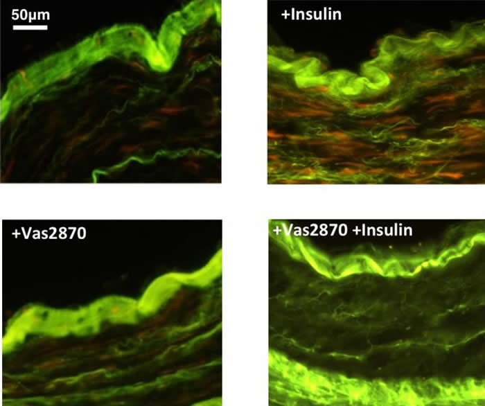 研究发现胰岛素如何促成动脉粥样硬化中的血管功能障碍
