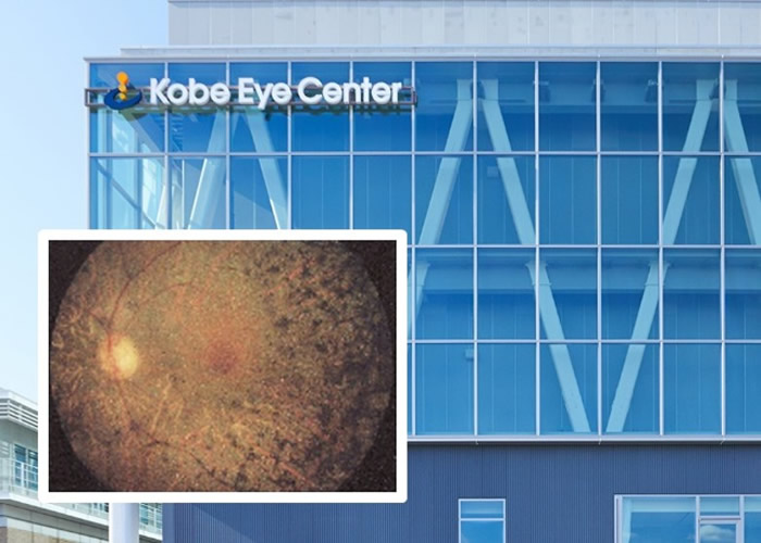 日本神户市立神户眼科中心医院实施全球首例iPS视细胞移植 有望成新疗法