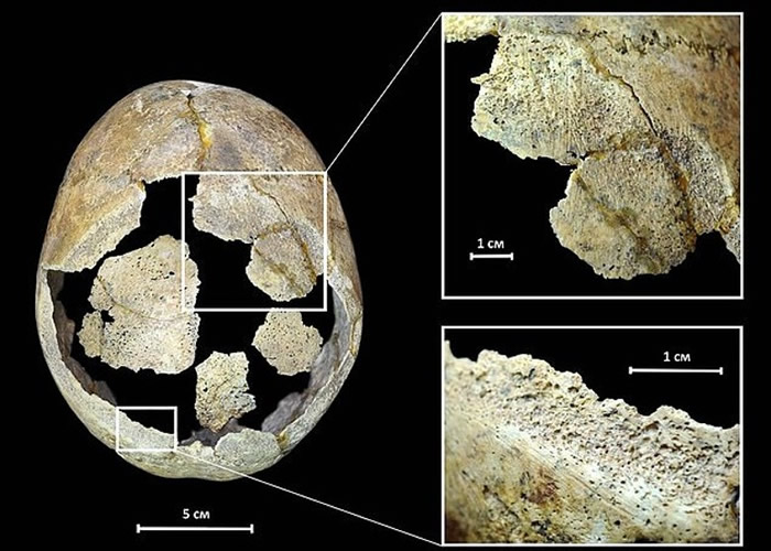 多布罗沃尔基娅认为骸骨主人曾接受开颅手术。