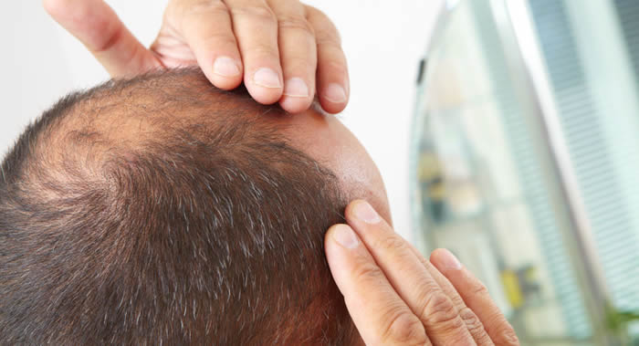 《Express》:英国科学家研究指红三叶草和中国蔷薇提取物有益于防止脱发