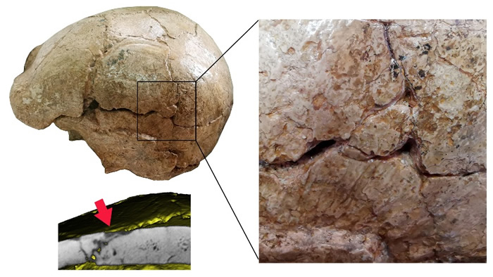 和县直立人头盖骨表面的裂痕(吴秀杰供图)