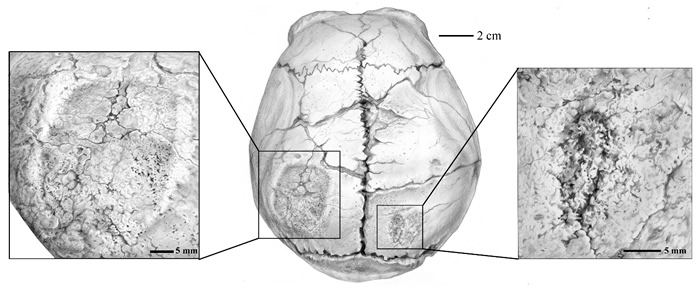 和县直立人头骨后部创伤痕迹(郭肖聪供图)