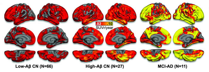 自动成像揭示阿尔茨海默氏病的脑中TAU蛋白起源