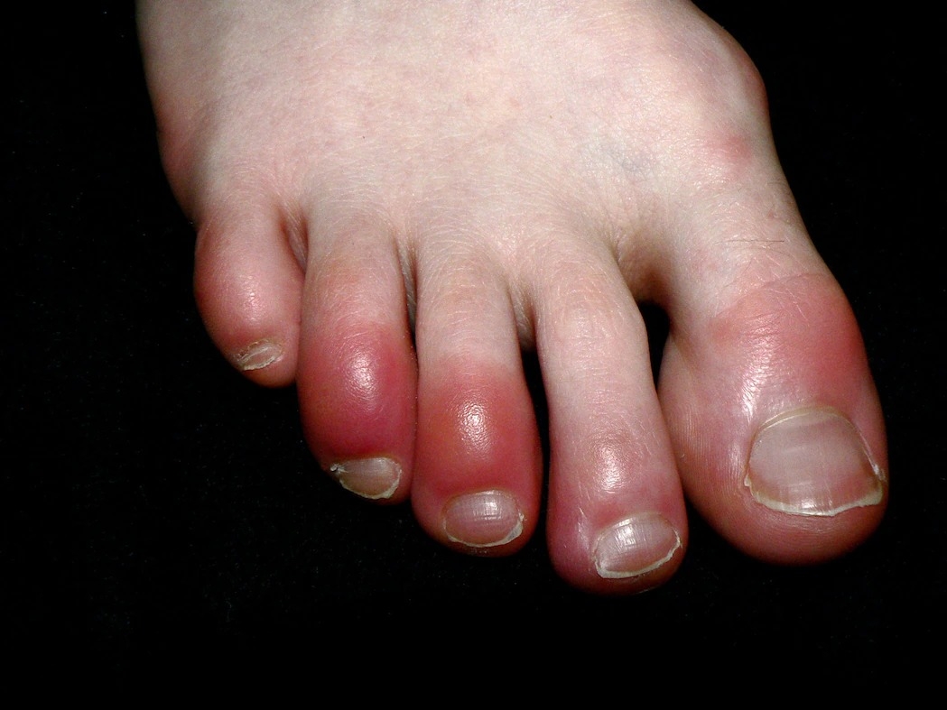 神秘的“COVID脚趾”使科学家困惑不解 COVID-19到底是不是罪魁祸首