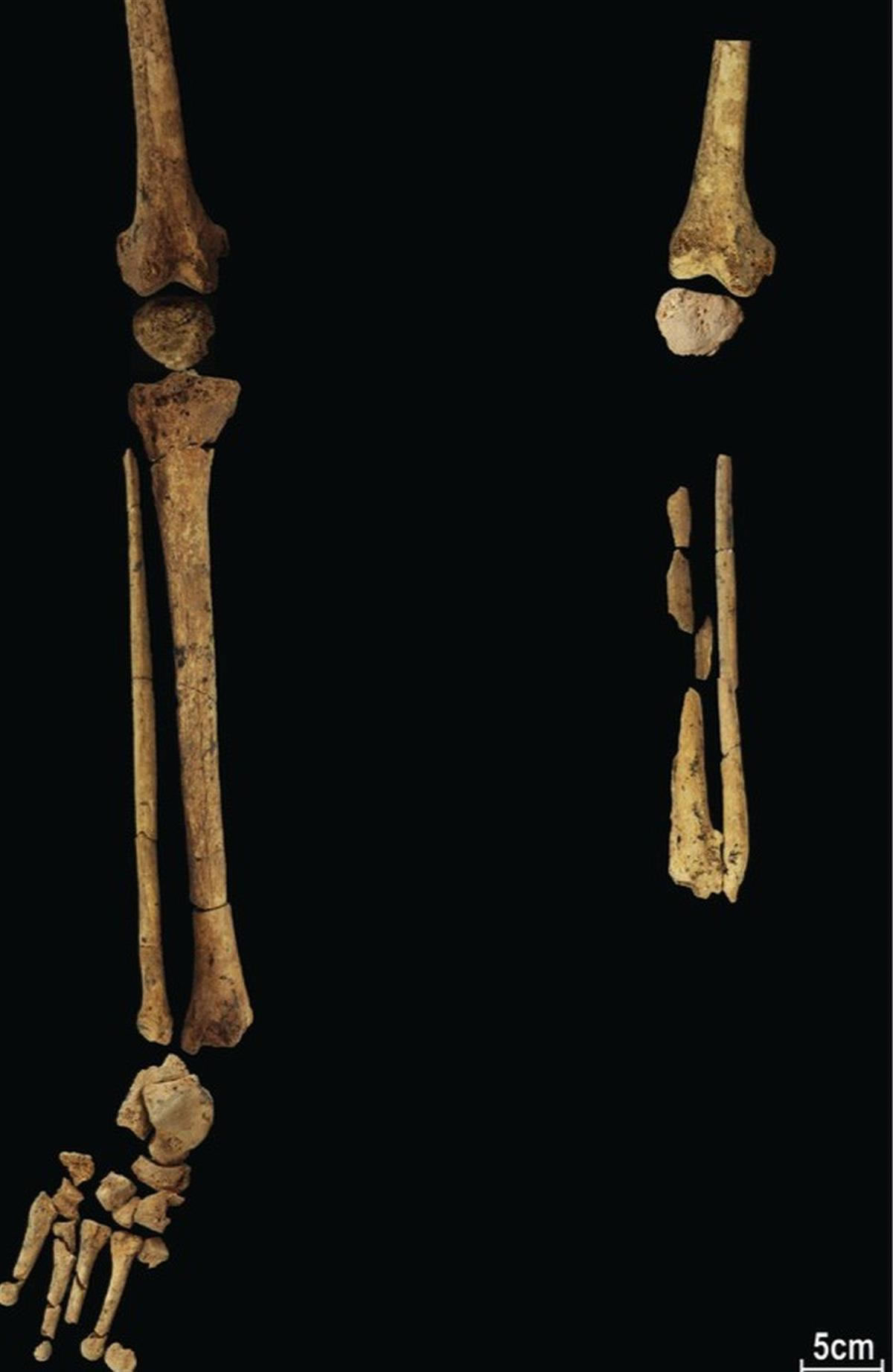 3.1万年前的截肢手术