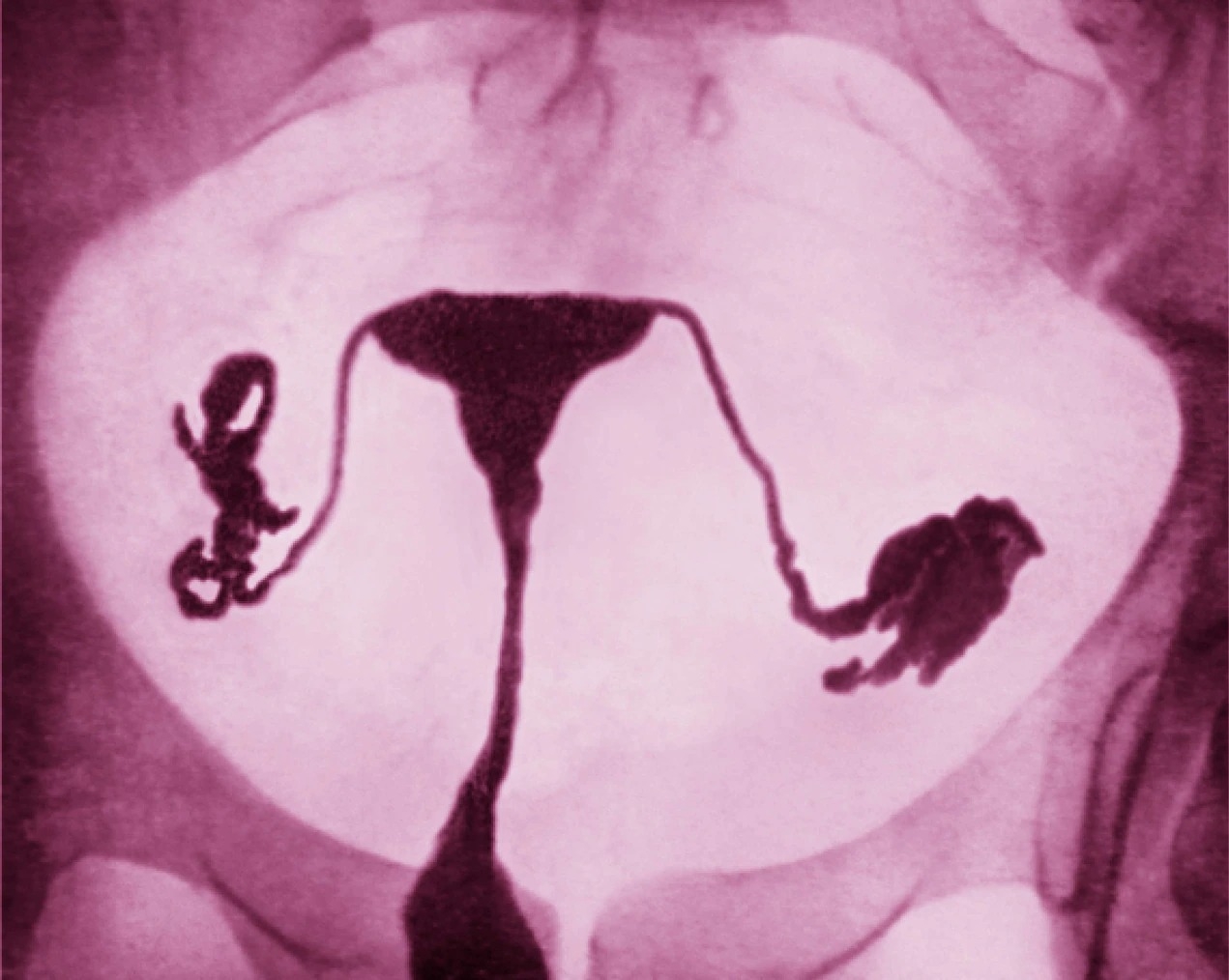 这张色彩增强子宫输卵管摄影显示女性生殖系统，包含输卵管和健康的子宫。PHOTOGRAPH BY JAMES CAVALLINI，SCIENCE SOURCE
