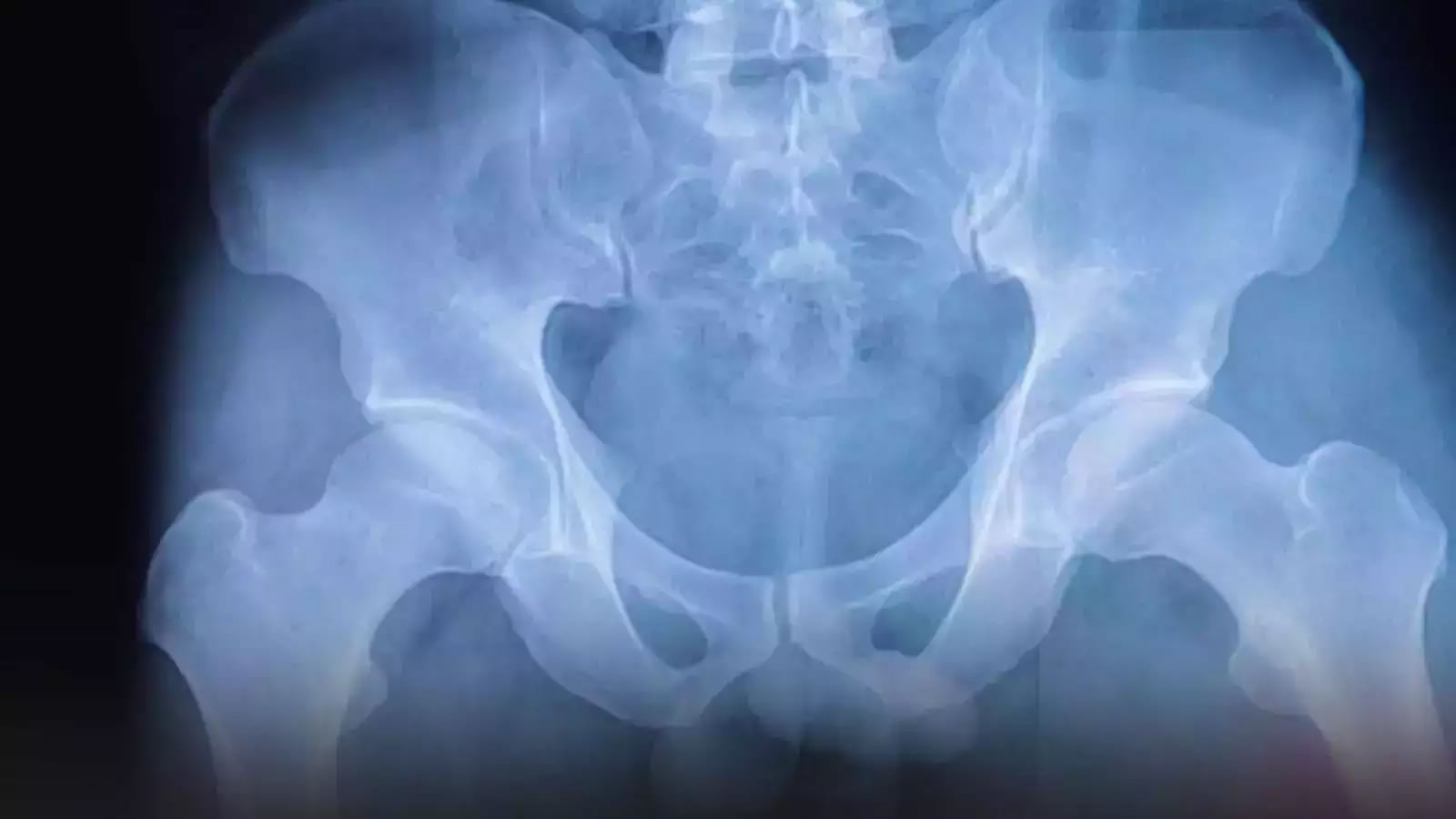 增加蛋白质摄入量和定期饮用茶或咖啡可能有助于降低女性髋部骨折的风险